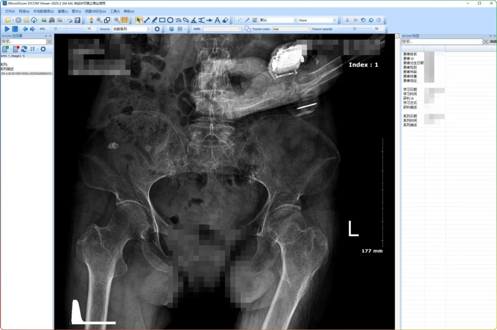 图片[1]-MicroDicom v2025.2.8154 汉化版：DCM 文件阅片器 - 搜源站-搜源站